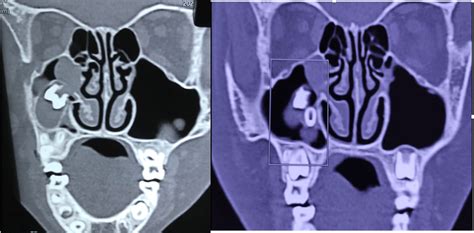 Computed Tomography Scan Of Paranasal Sinus Showing Dentigerous Cyst In