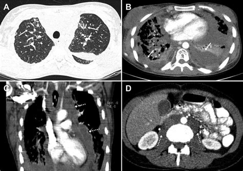 Axial Postcontrast Chest Ct In Lung A And Soft Tissue B Windows