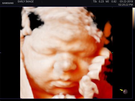 4d Ultrasound Early Image