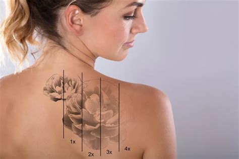 Laser Tattoo Removal Schweiger Dermatology Group