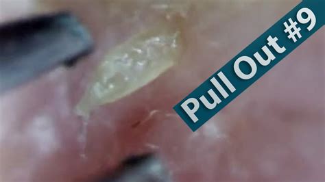 09 Pull Out Blackheads Close Up Blackheads Removal Youtube
