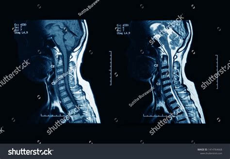Mri Scans Cervical Spine Without Contrast库存照片1414764668 Shutterstock