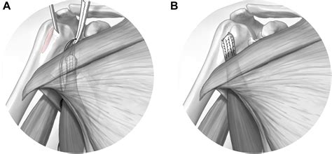 Latissimus Dorsi Transfer For Irreparable Subscapularis Tear Journal