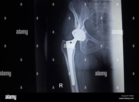 X Ray Scan Image Of Hip Joints With Orthopedic Hip Joint Replacement
