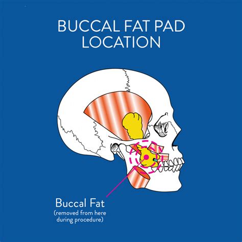 Buccal Fat Pad Reduction Procedure In Washington Dc Cheek Reduction
