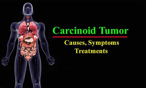carcinoid syndrome tumor causes symptoms treatment