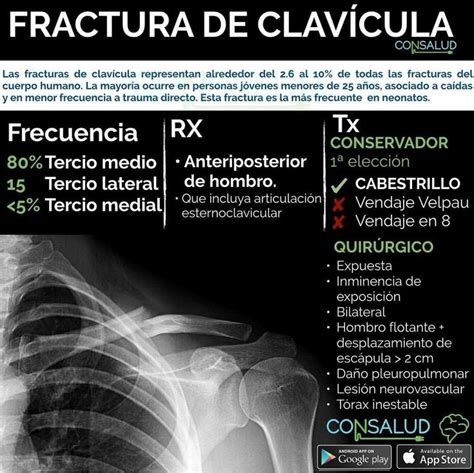 Fractura De Clavícula Radiology Medicine Med School