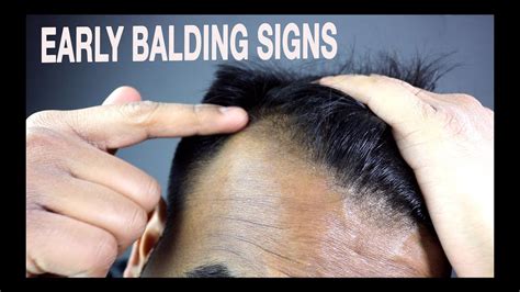 How To Know If Youre Going Bald Signs Of Male Pattern Baldness Youtube
