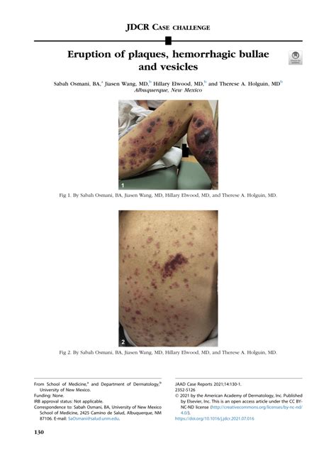 Pdf Eruption Of Plaques Hemorrhagic Bullae And Vesicles