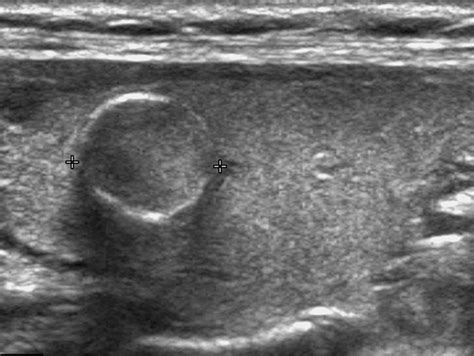 Thyroid Goiter Ultrasound