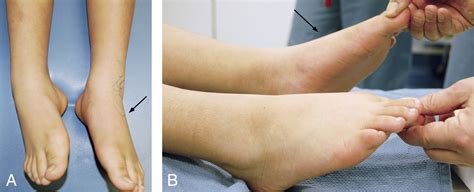 Treatment Of Tarsal Coalitions Musculoskeletal Key