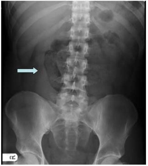 Plain Abdominal X Ray Showed A Single Loop Of Dilated Small Bowel