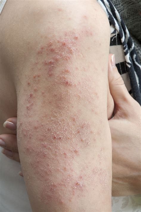 How To Tell If A Rash Needs Medical Attention