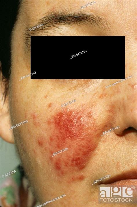 Acne Rosacea Stock Photo Picture And Rights Managed Image Pic Bsi