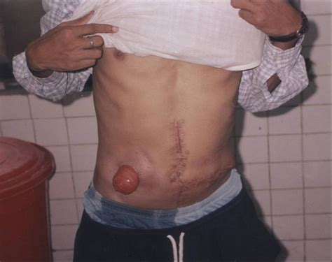 Medical Pictures Info Colostomy