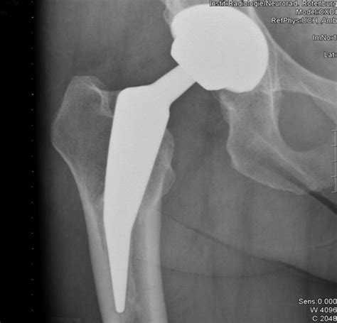 Minimally Invasive Anterolateral Approach Hip Arthroplasty