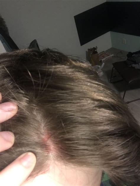 Red Wet Patch On Scalp Any Ideas Tressless