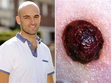 Man Reveled Shocking Diseases After Find Mole On Back After Returning