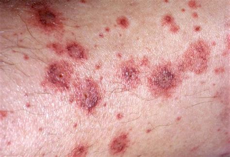 Vasculitic Lesions Pictures Symptoms And Pictures
