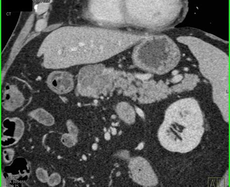 Serous Cystadenoma Of The Pancreas Pancreas Case Studies Ctisus Ct