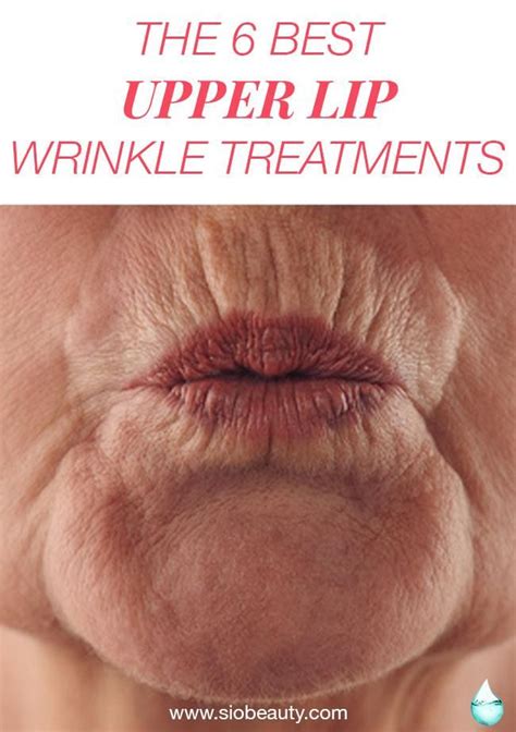 The 6 Best Upper Lip Wrinkle Treatments Lip Wrinkle Treatment Upper