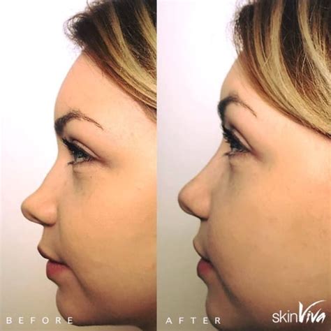 Non Surgical Nose Job Photos Before And After Skinviva