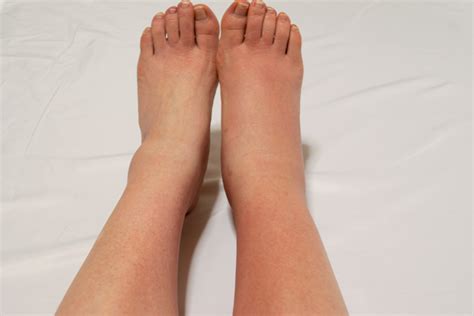 10 Causes For Swollen Feet Why Your Feet Ankles Legs Swell Lupon Gov Ph