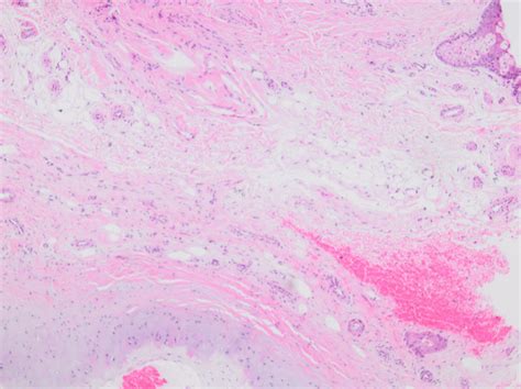 Pseudocyst Of The Auricle Cystic Chondromalacia Endochondral