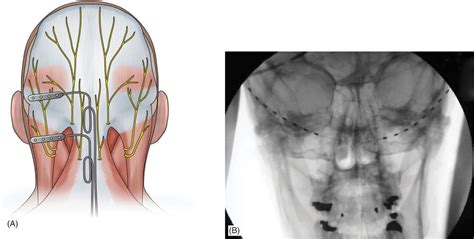 Percutaneous Peripheral Nerve And Field Stimulation Anesthesia Key