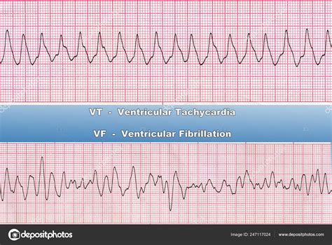 Ventricular Fibrillation Ecg