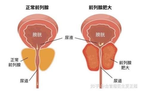 论文报道前列腺增生动脉栓塞术优势突出一根细丝解决前列腺增生 知乎