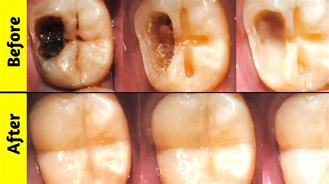 Перевод песни armed to the teeth — рейтинг: Reverse Cavities And Heal Tooth Decay With These 5 Steps ...