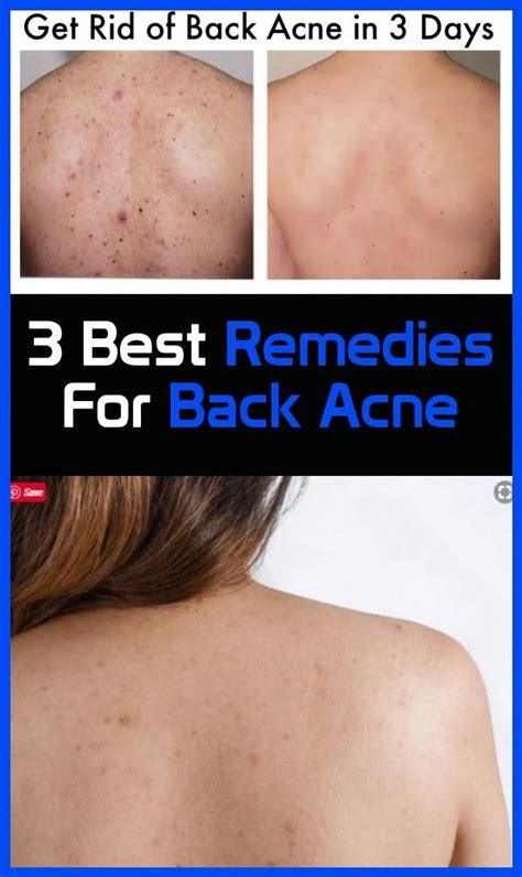 3 Best Remedies For Back Acne In 2020 Back Acne Remedies Best Acne