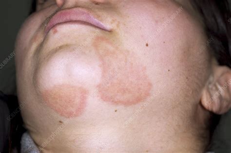 Tinea Fungal Infection On The Face Stock Image C0142537 Science