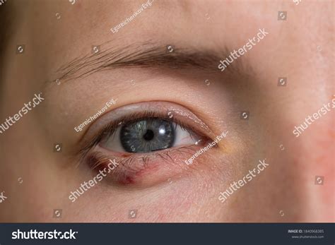 Close Blepharitis Eyelid Inflammation Eyes Stock Photo 1840968385