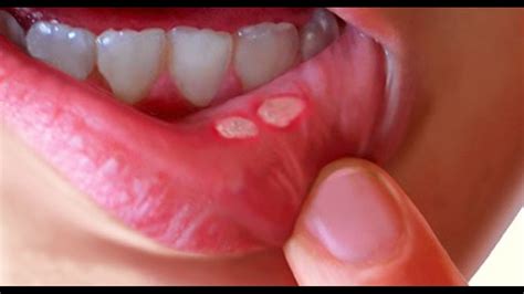 Ulcer Ulcerative Lesions Of The Oral Cavity Youtube