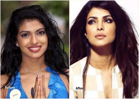 Priyanka Chopra Plastic Surgery Before And After Lip Job And Lip Job Con Imágenes Celebridades