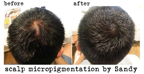 Scalp Micropigmentation Bald Spot Scalp Micropigmentation The Bald