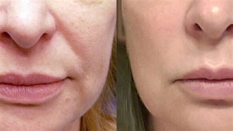 Is Thread Lift Effective Which Is Better Thread Lift Or Ultherapy