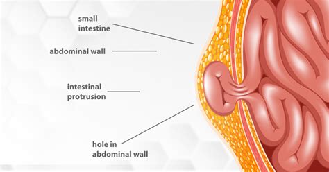 Hernia Causes Symptoms And Treatment At Omni Hospitals Omni Hospitals