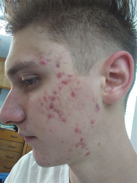 Mild Cystic Acne Cheeks