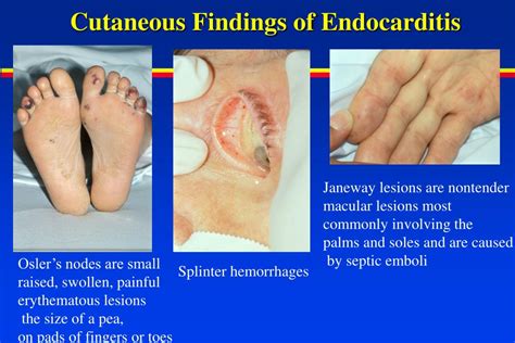 Ppt Epidemiology Of Infective Endocarditis Powerpoint Presentation