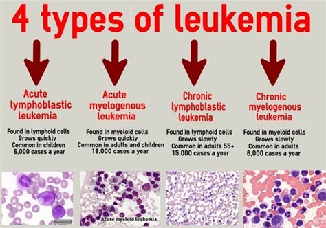 Blood Cancer Types And Symptoms