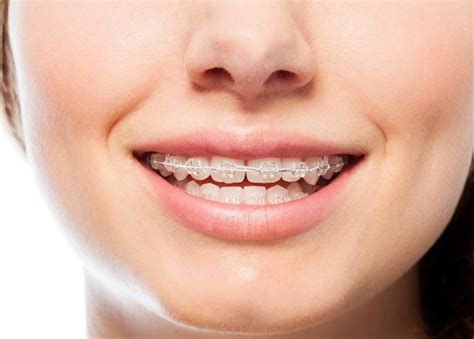 Overbite Before And After Braces How To Fix An Overbite With Braces