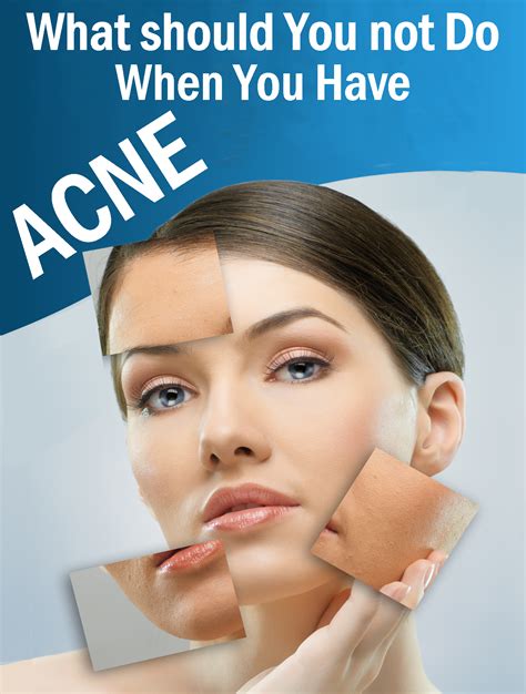 What Should You Not Do When You Have Acne In 2020 Acne Health And