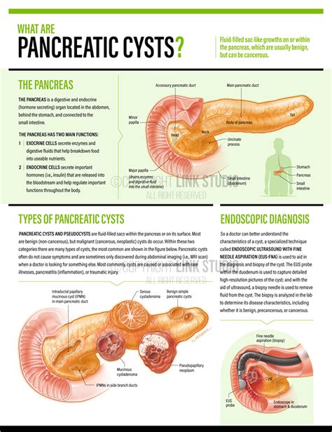 Pancreatic Cysts Link Studio Medical Illustration