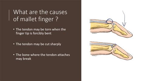 Mallet Finger Explained By Dr Alexander Anzarut YouTube
