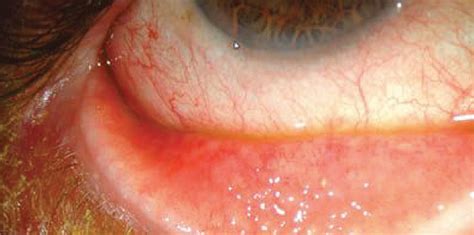 Lesson Conjunctivitis Know Your Differentials