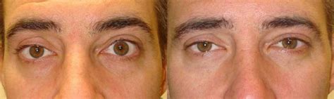 Upper Eyelid Retraction Before After Photos Taban Md Oculoplastic