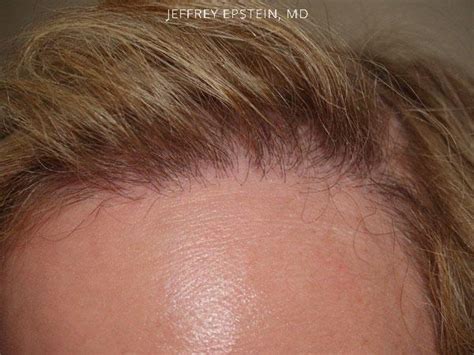 Patient 41320 Foundation For Hair Restoration